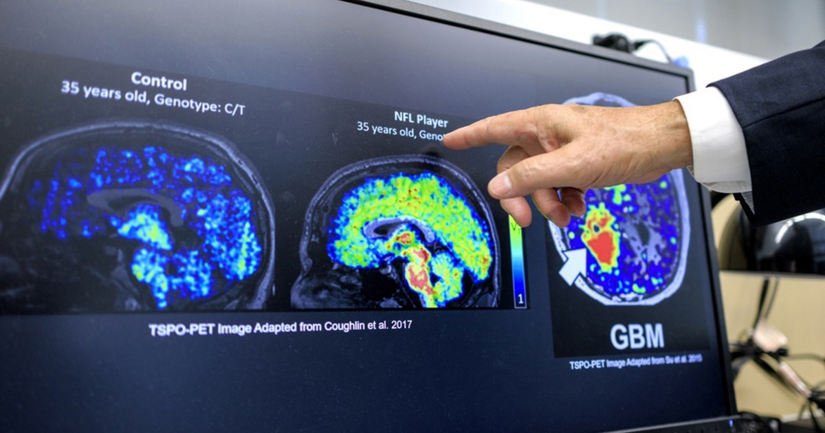 Grčki znanstvenici razvili molekulu za Alzheimerovu bolest. Rezultati su obećavajući