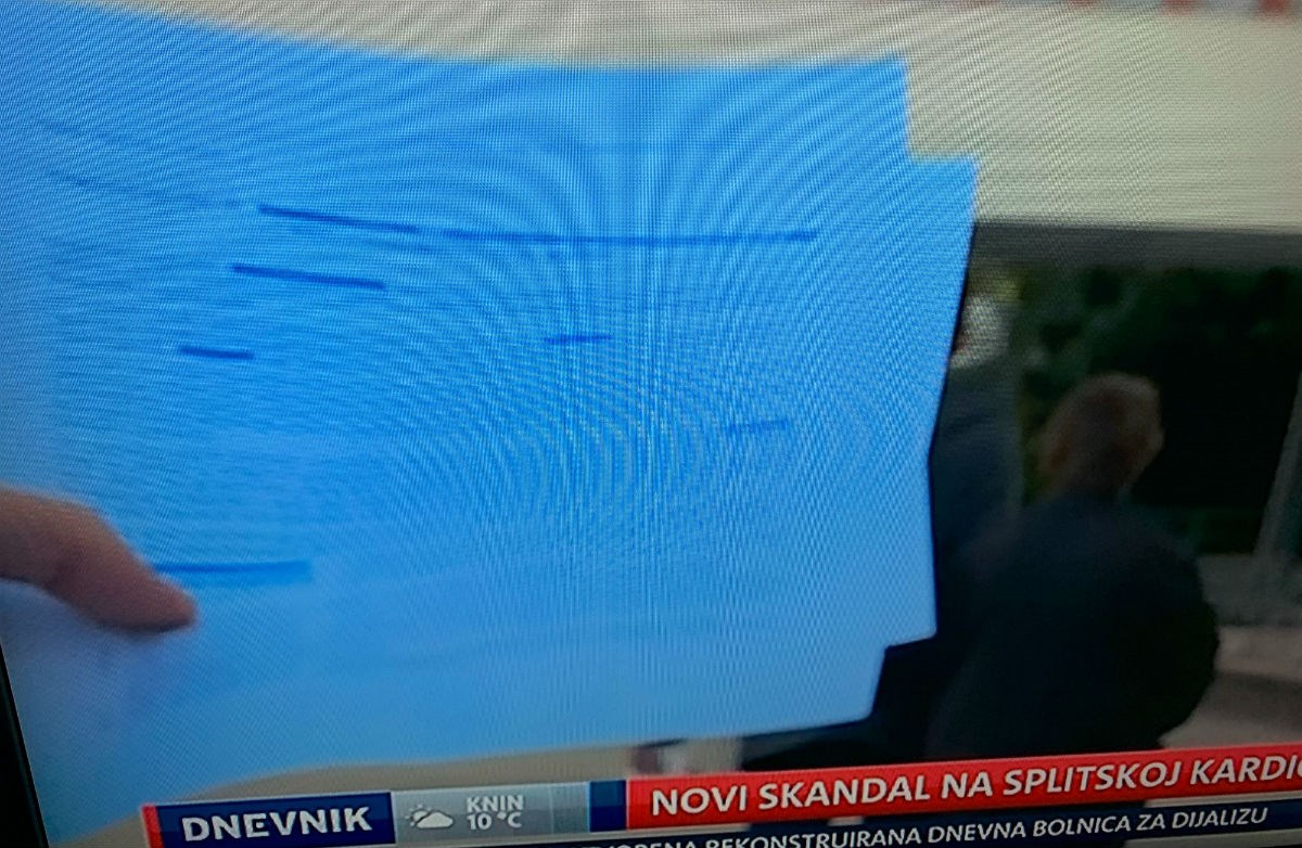 Splitski kardiokirurg pod istragom zbog 25 spornih operacija, 4 pacijenta umrla