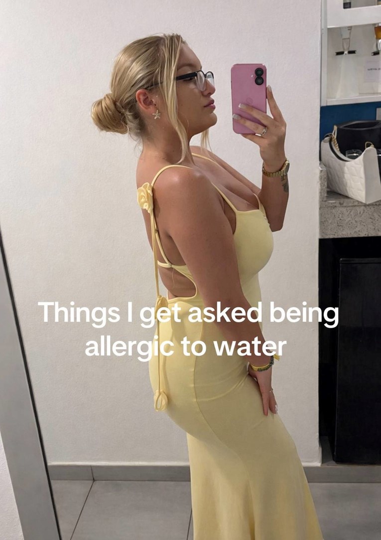 Djevojka (23) već 10 godina je alergična na vodu: "Misle da lažem i da se ne tuširam"