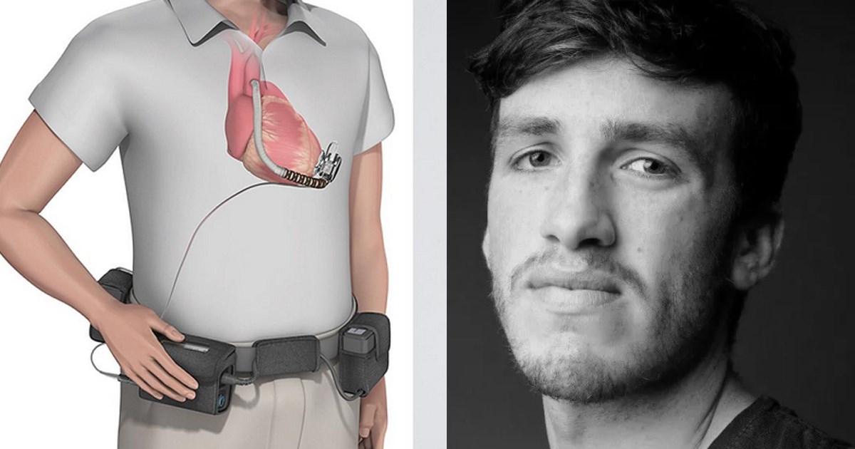 Pumpa za srce s visokom stopom smrtnosti godinama ugrađivana pacijentima u Britaniji