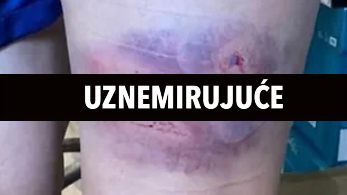 Ovako izgleda noga nogometašice PSG-a nakon brutalnog napada