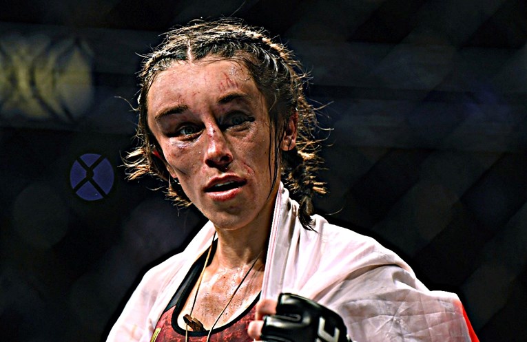 UFC borkinja pokazala kako izgleda nakon deformacije lica. Skoro se oporavila