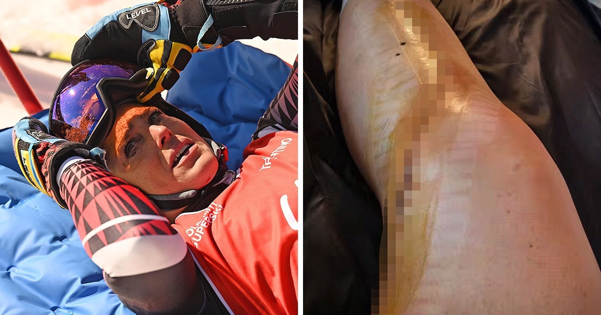 UZNEMIRUJUĆE Najbolja skijašica svijeta objavila sliku noge nakon pada i operacije