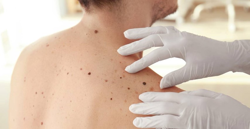 Istraživanje: Najsmrtonosniji oblik raka kože nije melanom