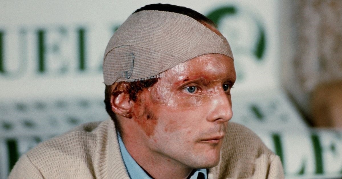 Izgorilo mu je pola lica, a on se vratio za samo 42 dana i s ponosom pokazao ožiljke