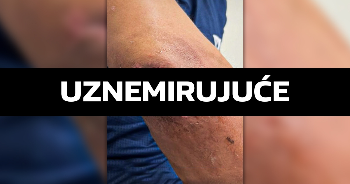 FOTO UFC-ovom borcu infekcija uništava lakat. Objavio je fotku i šokirao fanove
