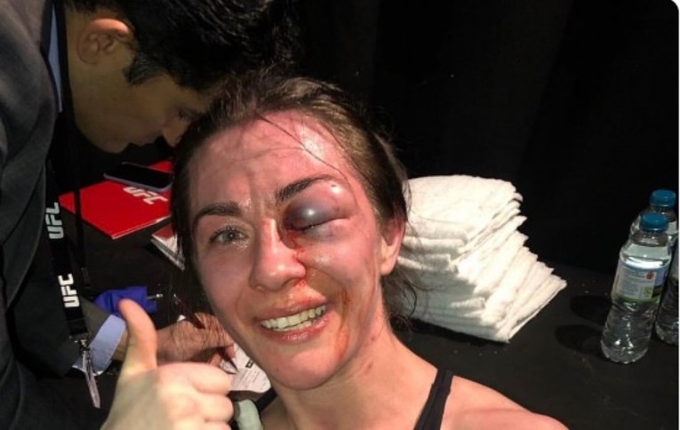 Zastrašujuća ozljeda u UFC-u: Nakon povijesne pobjede, završila na operaciji oka