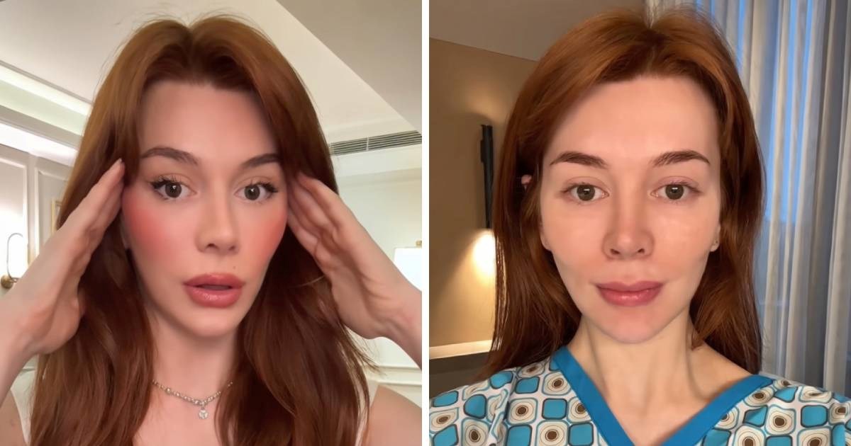 Tiktokerica (28) otišla na facelifting: "Stalno su me uspoređivali sa Simpsonima"