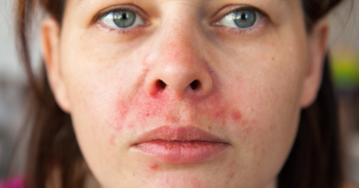 Perioralni dermatitis: Zašto se javlja i kako ga prepoznati?