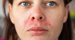 Perioralni dermatitis: Zašto se javlja i kako ga prepoznati?