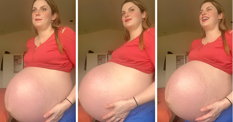 Mama koja je rodila trojke pokazala kako joj je izgledao trbuh dan prije porođaja