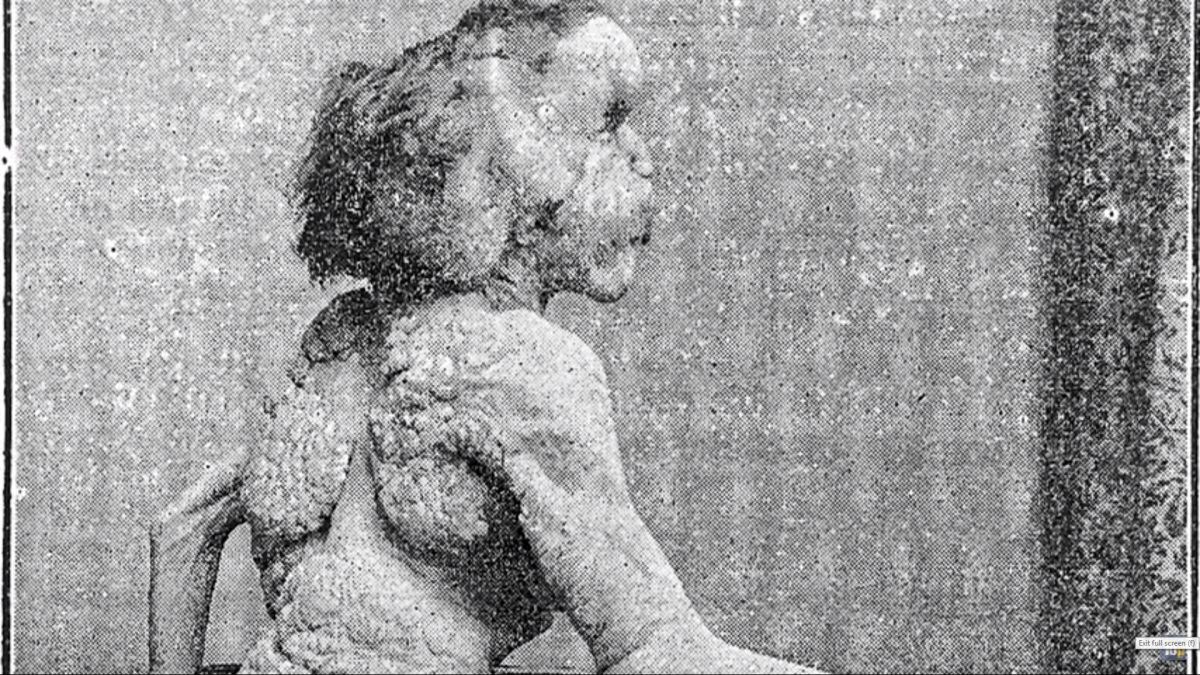 Nakon 130 godina pronađen grob "čovjeka-slona"?