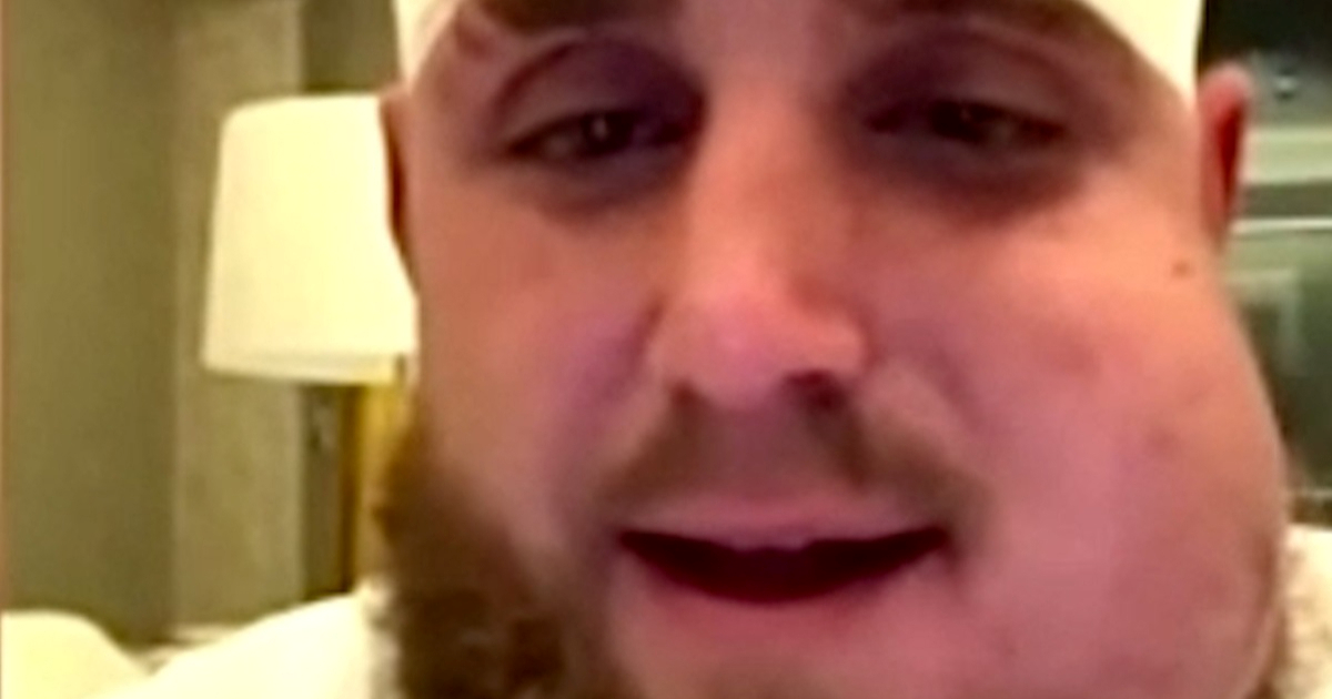 Ovako izgleda Paul nakon što mu je Joshua na dva mjesta slomio čeljust