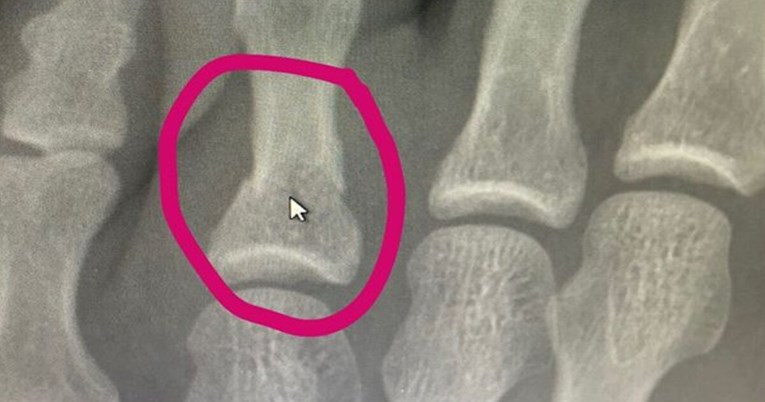 Khabib objavio fotografiju napuklog prsta prije borbe s Gaethjeom