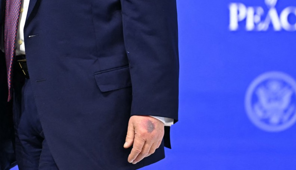 Trump se pojavio u Davosu s novom masnicom na ruci