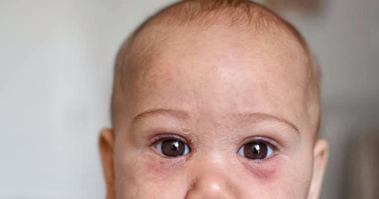 Beba dobila ospice jer je bila premala za cjepivo, mama objavila fotografije