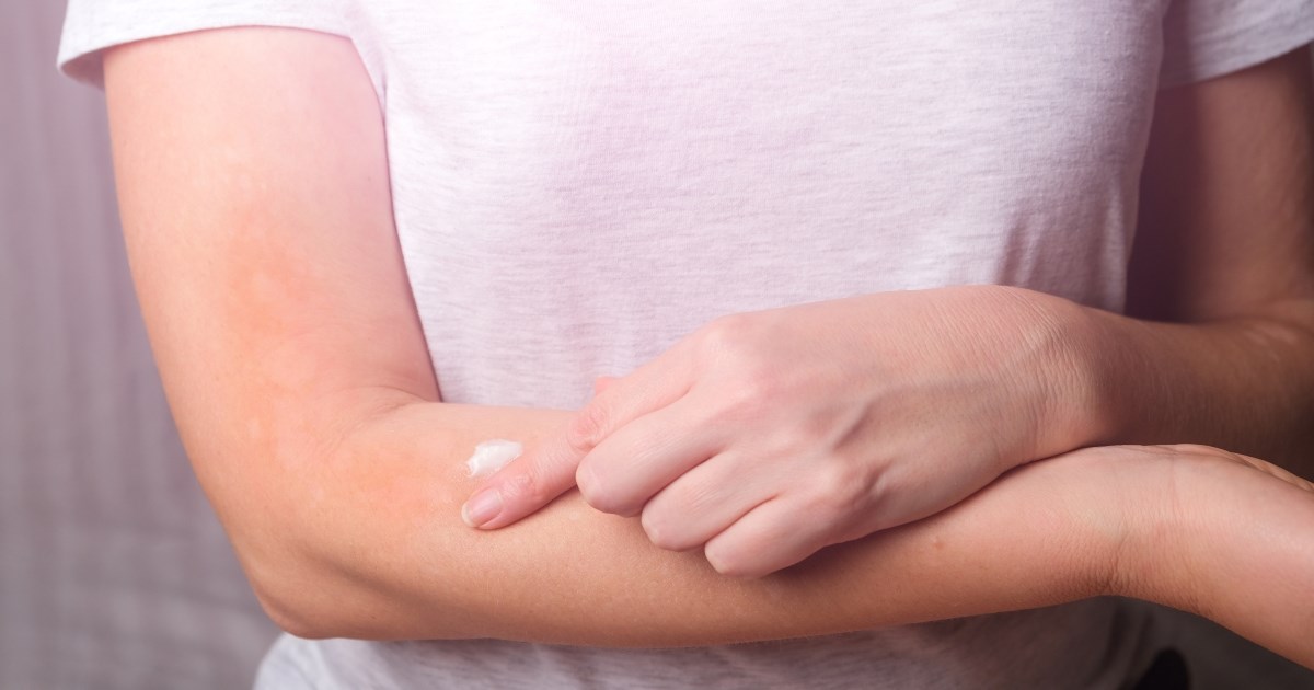 Neurodermatitis: Zašto se javlja i kako ga prepoznati?