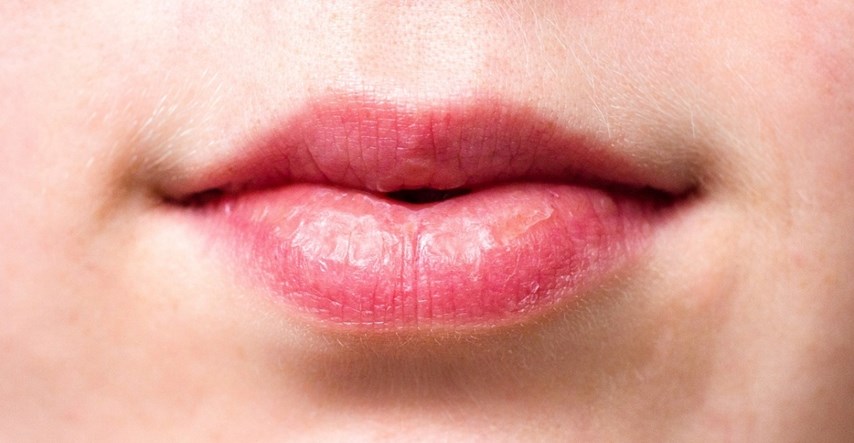 Što više mažete usne balzamom, one su suše? Dermatolog objasnio zašto