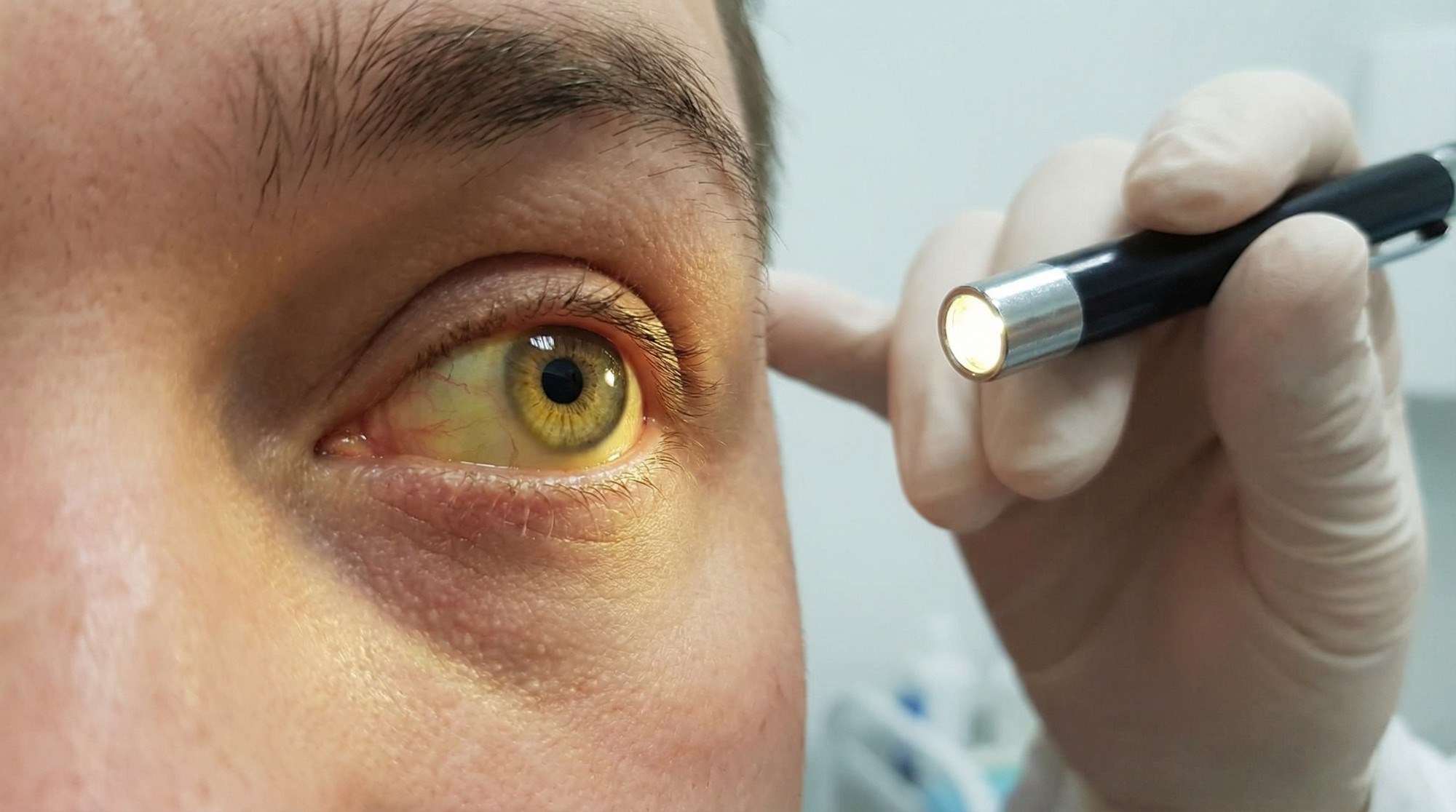 Suptilan simptom raka gušterače. Obratite pozornost na žutilo kože i očiju