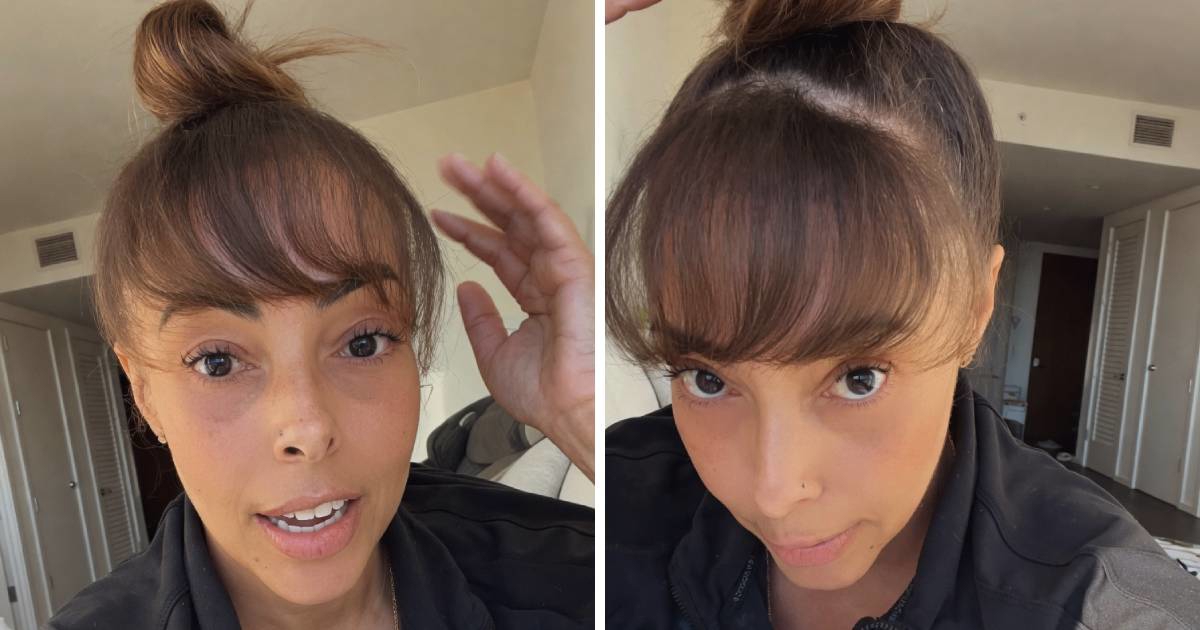 Otišla na transplantaciju kose pa pokazala rijetku nuspojavu