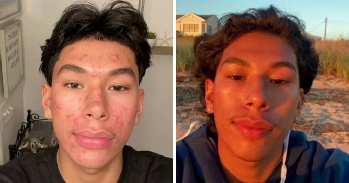 Bivši korisnik o travi tvrdi da mu je ta navika uništila kožu. Pokazao je fotografije