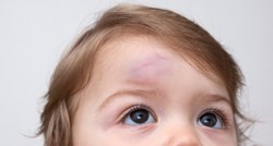 Prva pomoć: Ovo su znakovi da dijete treba hitnu pomoć ako se udarilo u glavu