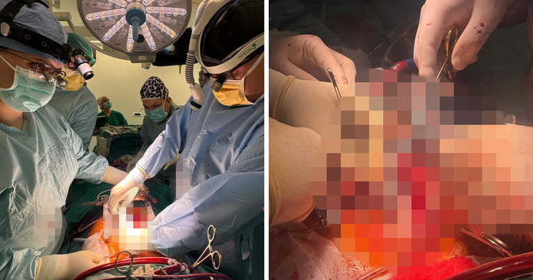 Povijesna operacija u Splitu, pacijentu ugradili umjetno srce. "Bio je na rubu smrti"