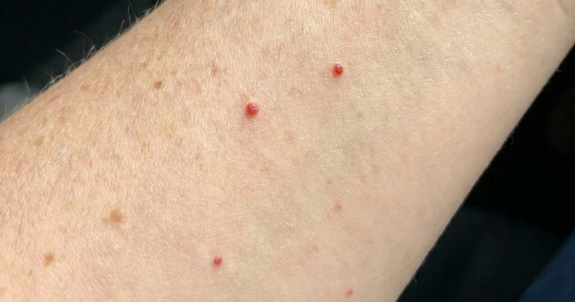 Što su one male crvene točkice na koži i trebaju li vas brinuti?