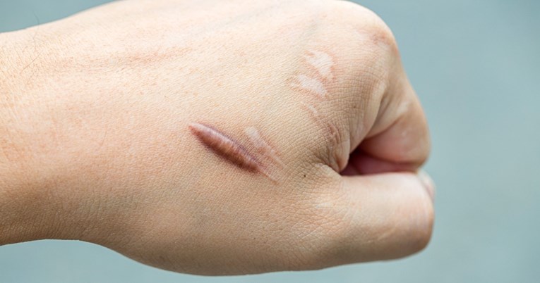Ako ste skloni ožiljcima, evo što to može govoriti o vašem zdravlju