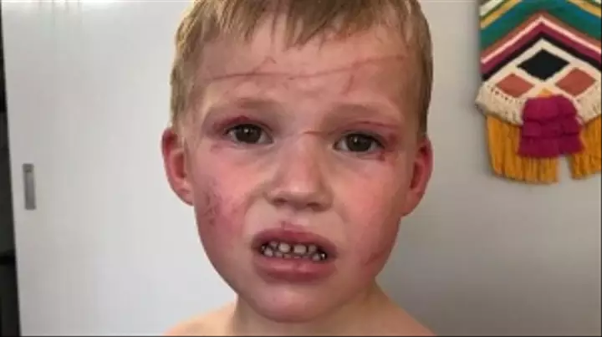 Otac spasio 5-godišnjeg sina od brutalnog napada klokana