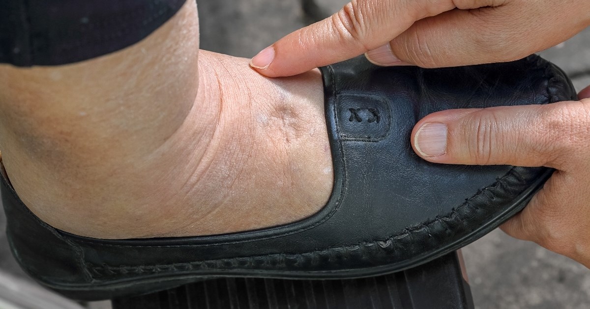 Tri simptoma srčanih bolesti koji se mogu javiti u stopalima