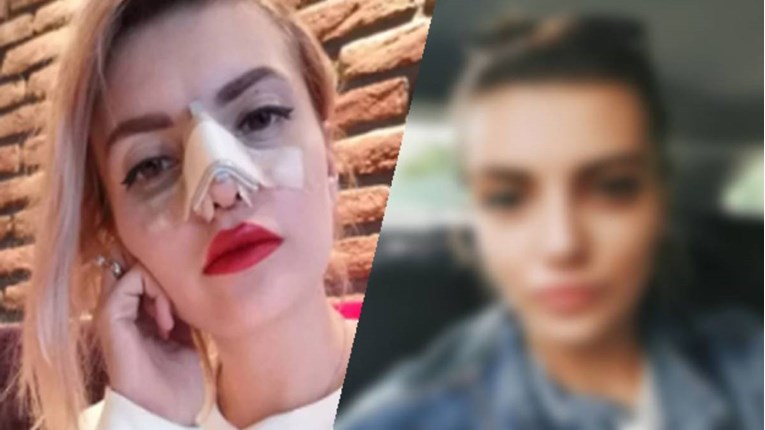 Ella Dvornik objavila prvi selfie nakon plastične operacije nosa