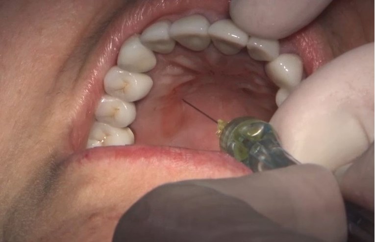 Zubar mu otkrio nešto čudno u ustima, nastalo je zbog previše oralnog seksa