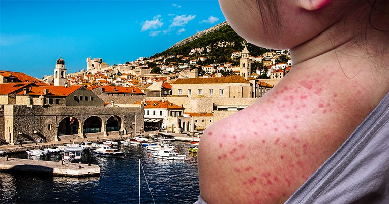 Potvrđen treći slučaj ospica u Dubrovniku