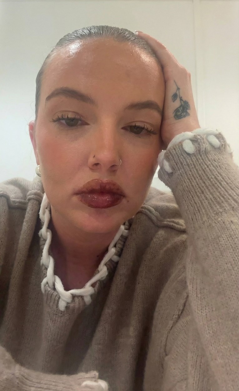 Platila 460 eura za popularan tretman usana pa pokazala što joj se dogodilo