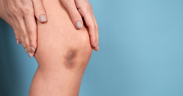 Rani znakovi nedostatka vitamina C koje ne biste smjeli zanemariti