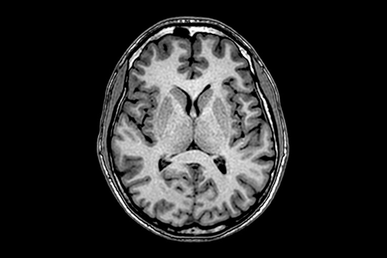 Otkriven novi genetski poremećaj, mogao bi objasniti tisuće slučajeva