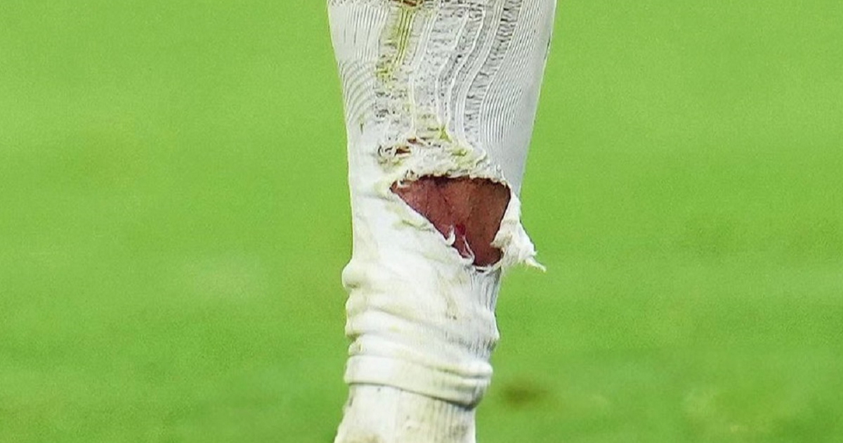 Viralna je slika Mbappeove noge. "Kako ovo nije za crveni karton Tahu?"