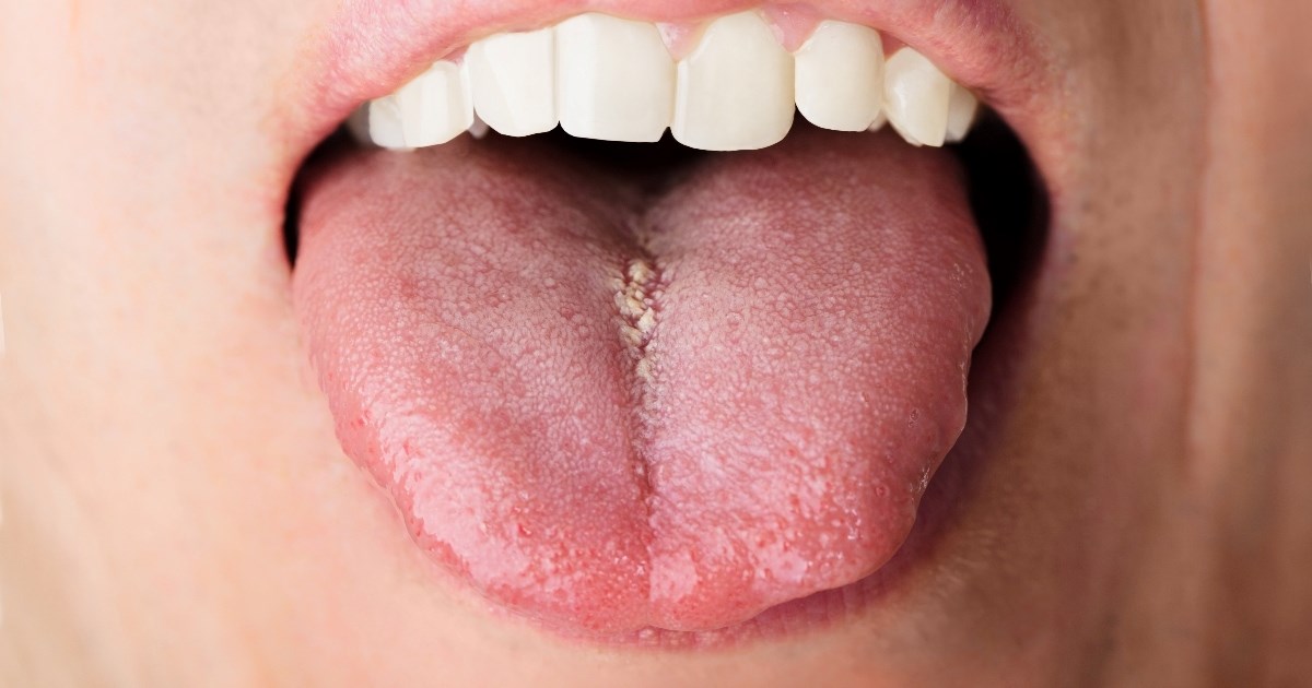 Promjene na jeziku mogu ukazati na nedostatak B12, a posljedice mogu biti opasne