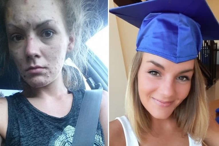 Podijelila fotke prije i poslije oporavka od heroina, teško ju je i prepoznati