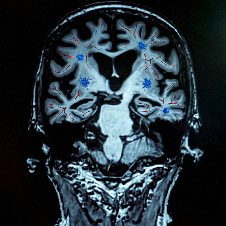 Otkriven gen odgovoran za većinu demencije i Alzheimera. Tko ga ima?