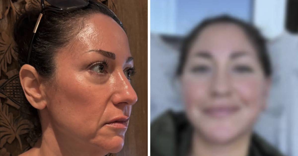 Amerikanka (49) otišla na facelifting u Meksiko: "Sada izgledam 20 godina mlađe"