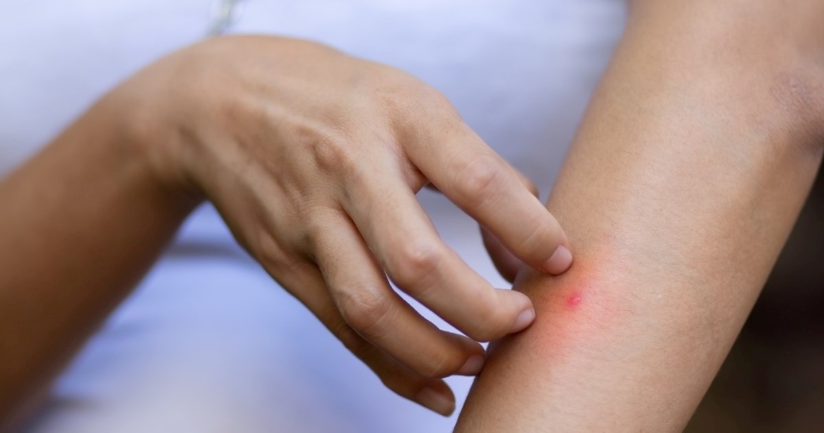 Napokon znamo zašto neke ljude komarci grizu više