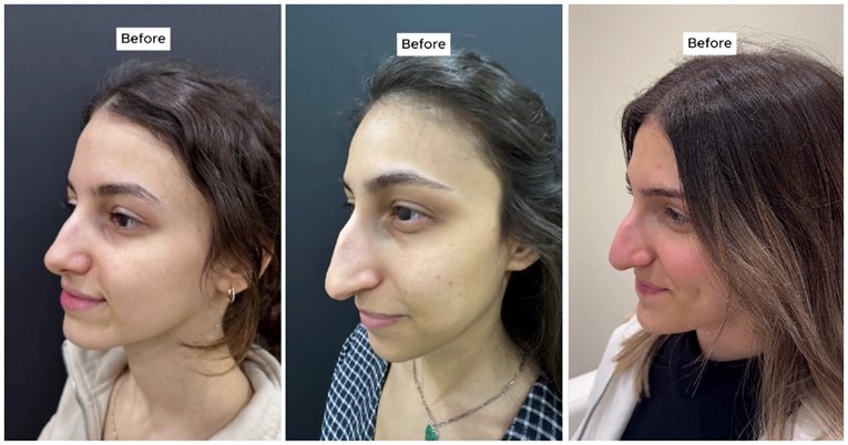"Roditelji ih neće prepoznati": Tri sestre otišle na operacije nosa, ovo je rezultat