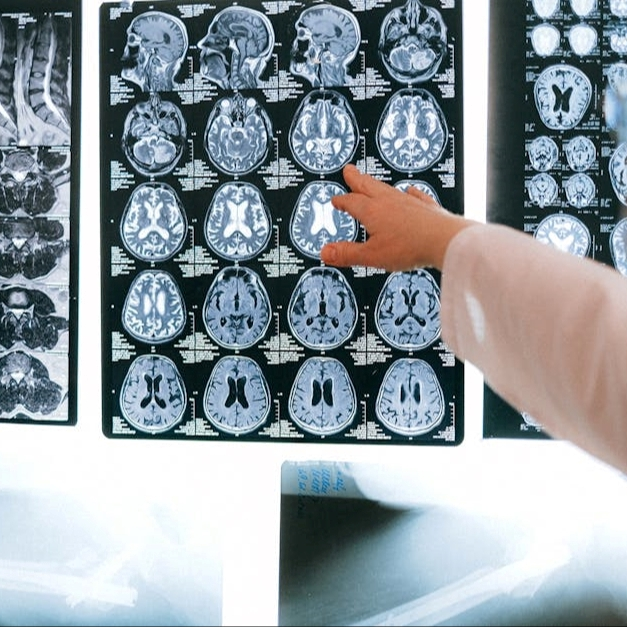 Omega-3 i Alzheimer: Ključna veza za zdravlje mozga kod žena