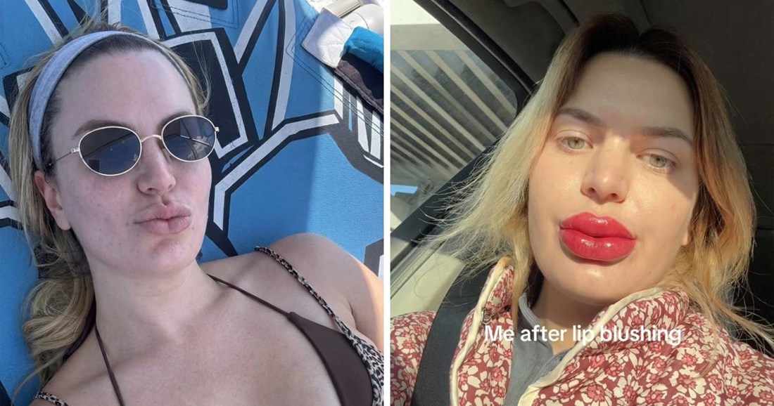 Tetovirala usne pa završila s ekstremnom oteklinom: "Izgledam kao lik iz crtića"