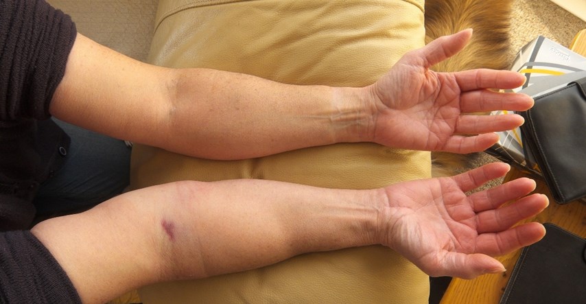 Liječnici upozoravaju da ove promjene na rukama mogu biti znak bolesti