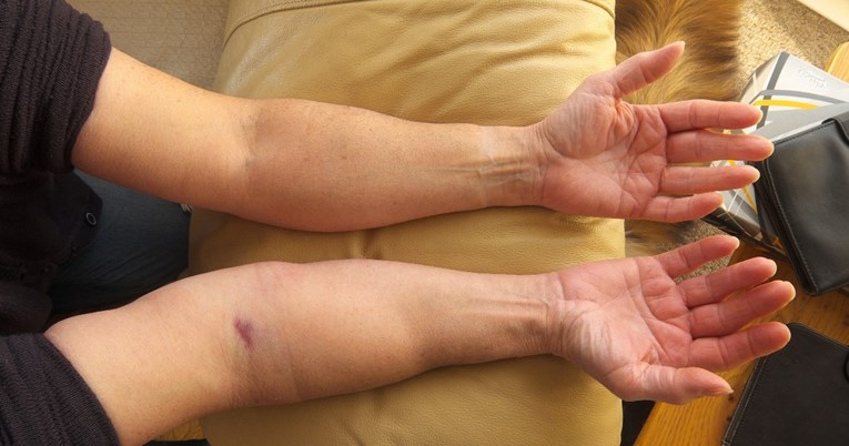 Liječnici upozoravaju da ove promjene na rukama mogu biti znak bolesti