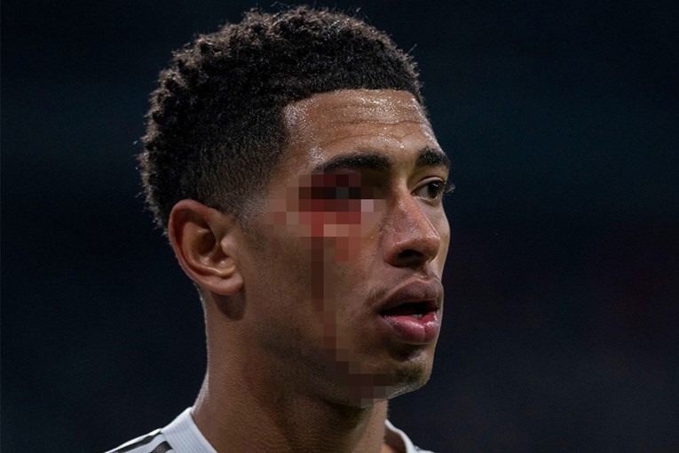 Bellingham je ovako izgledao nakon lakta u glavu. On je dobio žuti, a udarač ništa