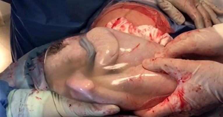 Beba rođena u vodenjaku spavala 7 minuta dok su je liječnici promatrali: Čudo života